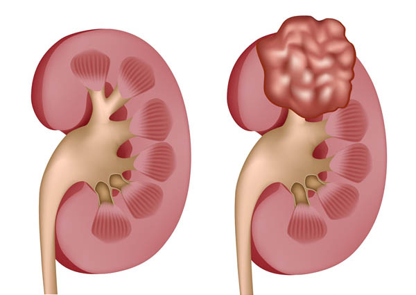 Carcinoma là gì? Các xác định Carcinoma