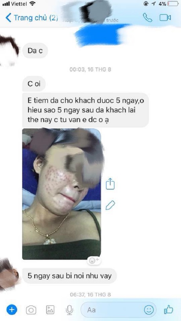 Sự thật về tiêm filler, botox giá rẻ